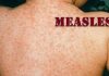 BELIZE-Health authorities advise vigilance following measles cases. Health official at podium with measles prevention poster and map of Belize