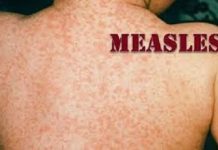 BELIZE-Health authorities advise vigilance following measles cases. Health official at podium with measles prevention poster and map of Belize
